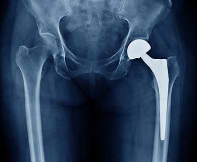 Hip Replacement